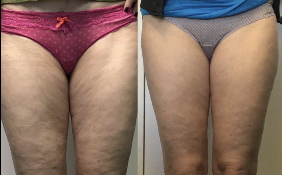 Vorher und nachher, Lymphdrainage mit Pressotherapie