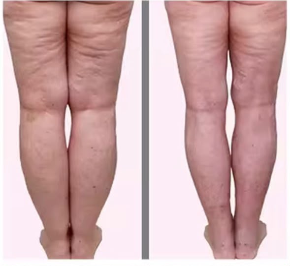 Vorher und nachher, Lymphdrainage mit Pressotherapie